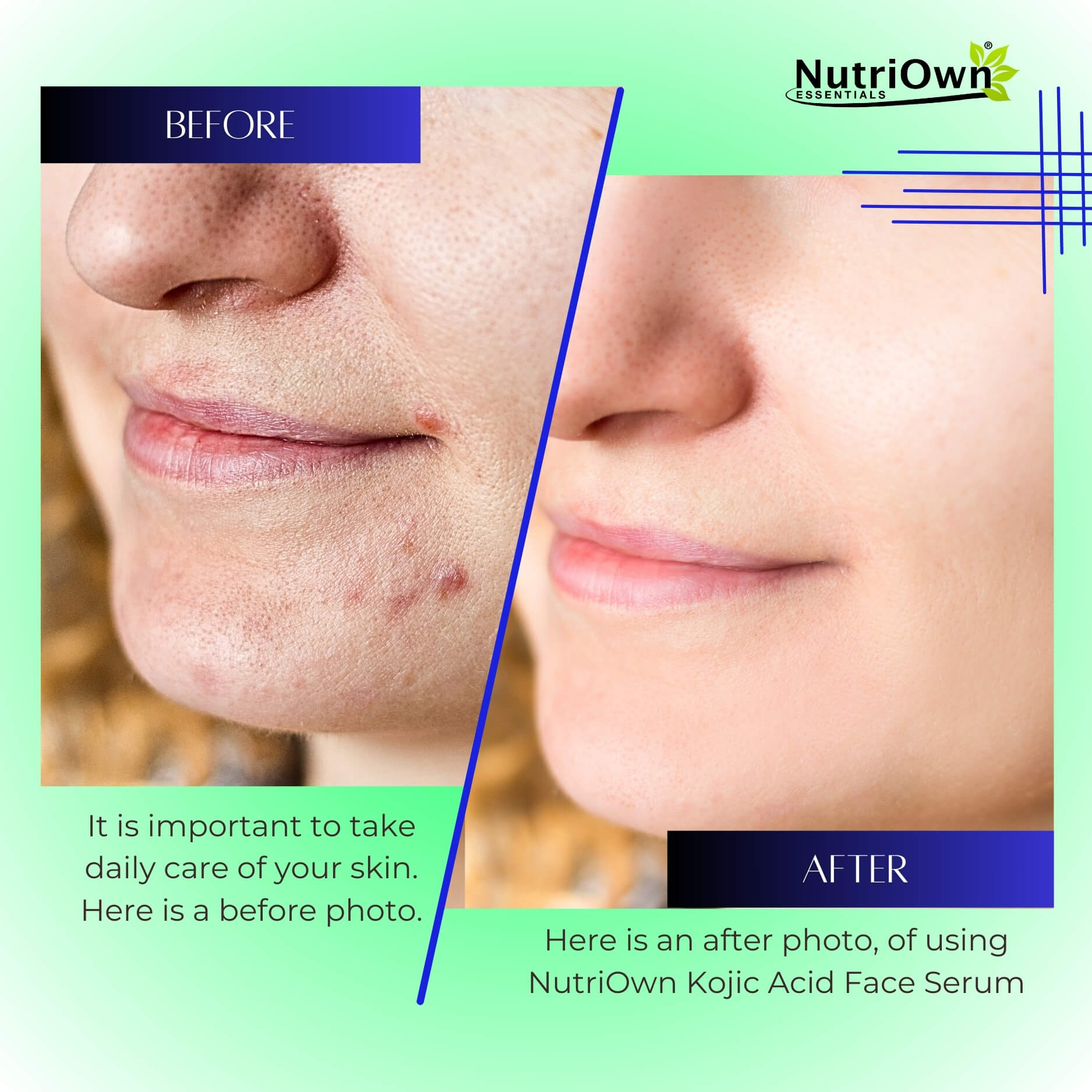 NutriOwn Kojic Acid Serum for Pigmentation Remove